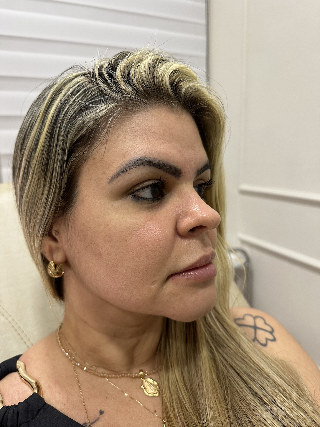 Antes - Preenchimento Labial