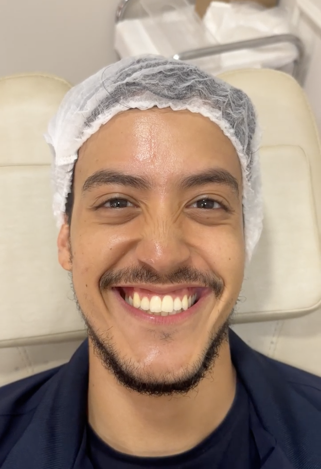 Antes - Tratamento para rugas e linhas de expressão + Peptídeos