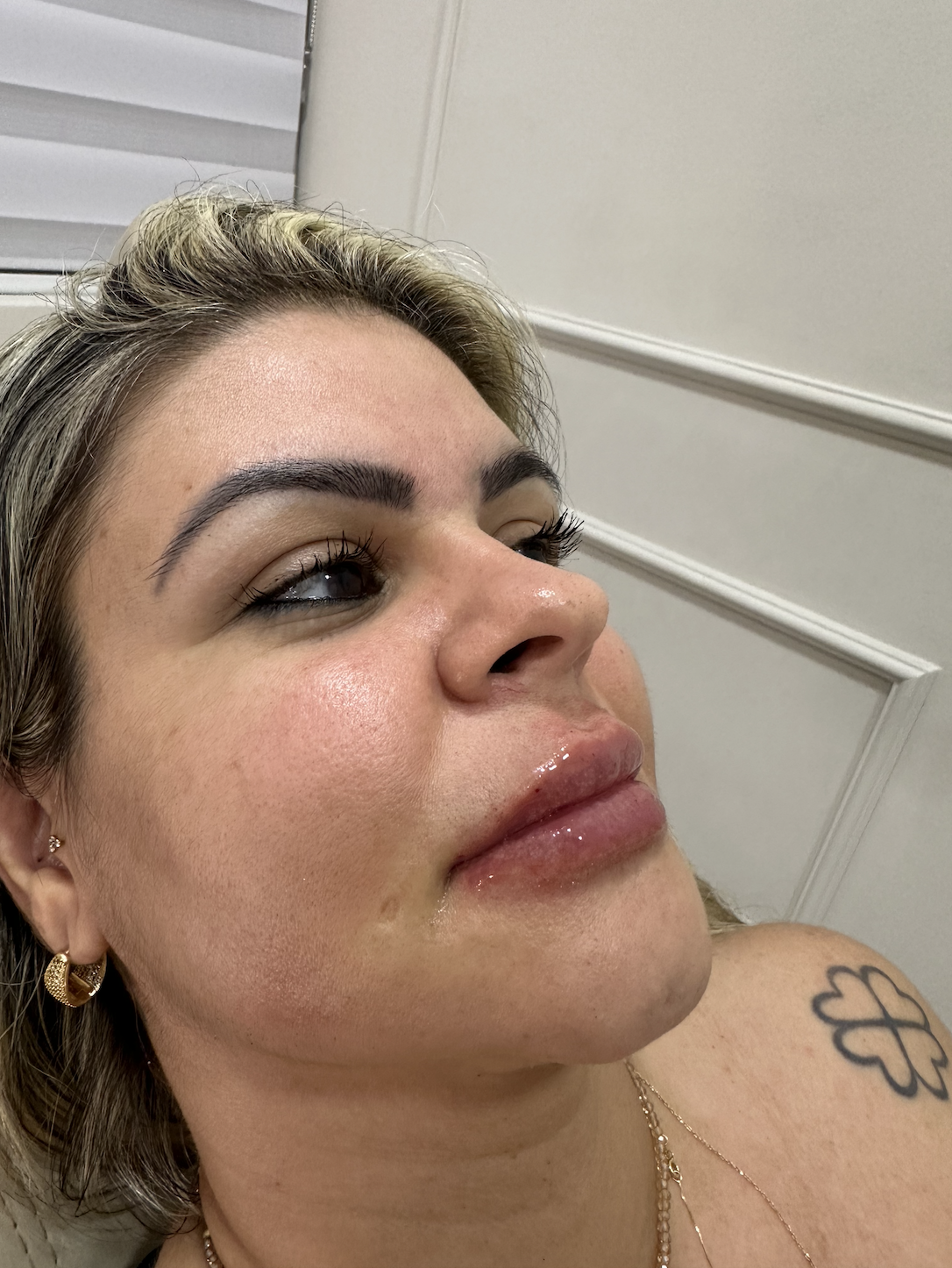 Depois - Preenchimento Labial
